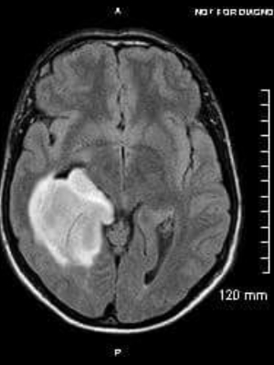 Zach's Anaplastic Astrocytoma