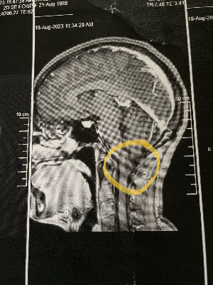 First MRI August 2023